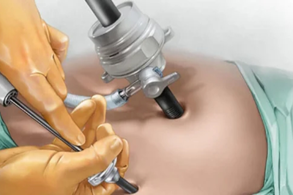 Hysteroscopy_ laparoscopy