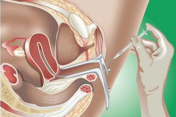 Iui
